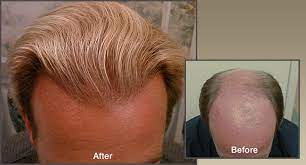 Best Hair Transplant Solution In Canada